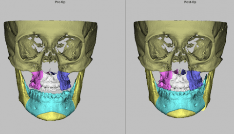 Cirugía ortognática: qué es, cuándo se necesita y cómo puede cambiar tu vida
