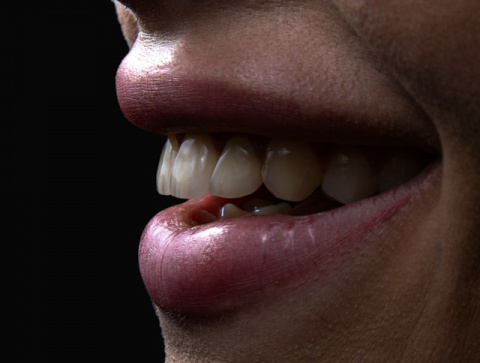 ¿Implante o puente dental? La decisión que puede marcar la salud de tu boca durante años
